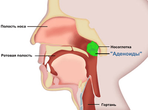 Остеопатия - аденоиды